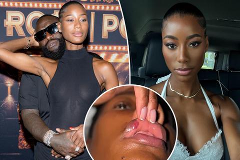 collage of Rick Ross, Jazzma Kendrick, and lip injury photo